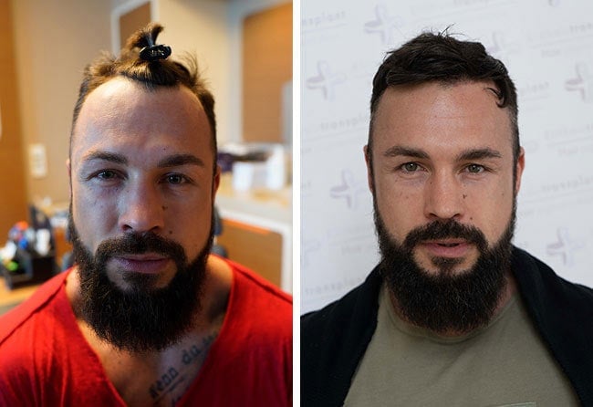 Vorher nachher Saphir Haartransplantation mit 2900 Grafts bei Patient Road to Glory