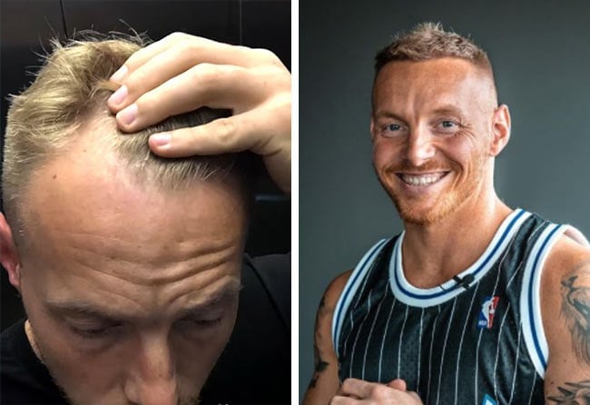 Vorher Nachher Saphir Haartransplantation mit 3100 Grafts bei Patient Coach Stef