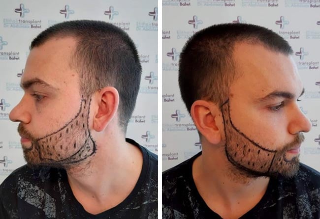 Vorher Saphir Barttransplantation mit 2700 Grafts bei Patient Nico Müller