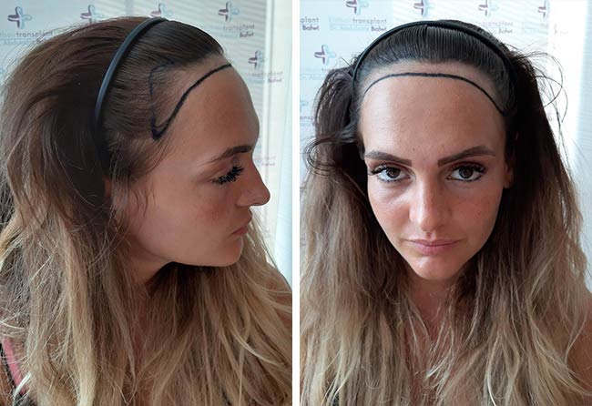 Vorher Saphir Haartransplantation mit 2200 Grafts bei Patientin Karin Baumann