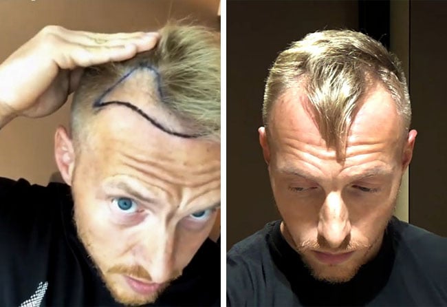 Vorher Saphir Haartransplantation mit 3100 Grafts bei Patient Coach Stef