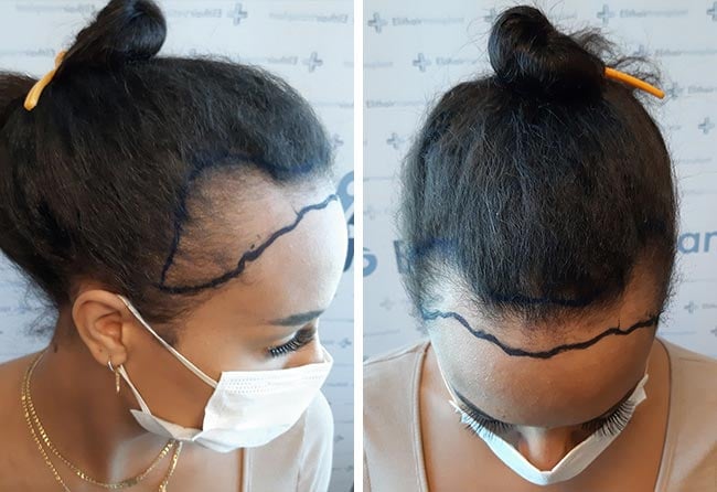 Vorher SDHI Haartransplantation mit 3200 Grafts bei Patientin Jahy C