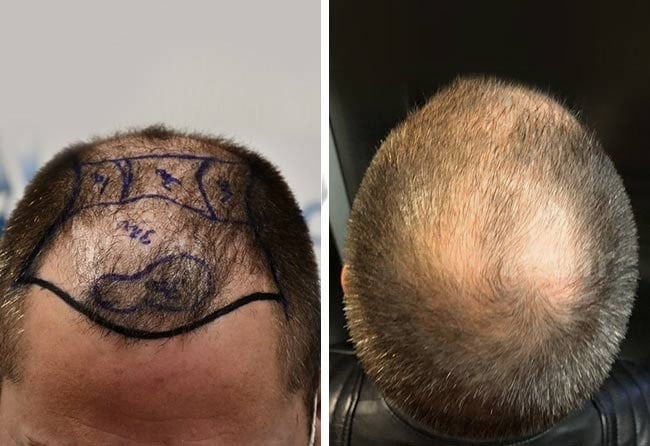Vorher DHI Haartransplantation mit 5200 Grafts bei Patient Andre
