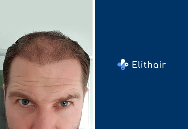 Vorher nachher Saphir Haartransplantation mit 4100 Grafts bei Elithair Patient nach 3 Monaten