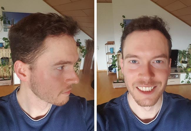 Nachher DHI Haartransplantation mit 3500 Grafts bei Patient Lukas Jäger