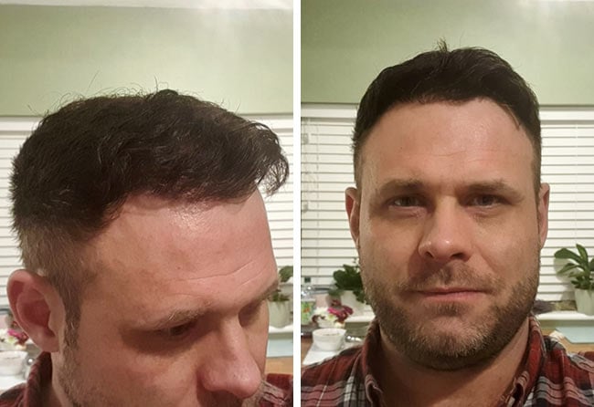 Nachher Perkutan Haartransplantation mit 3700 Grafts von Patient Michael Woulfe