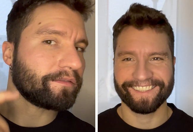 Nachher Saphir Barttransplantation mit 3500 Grafts bei Patient Dominik Schmitz