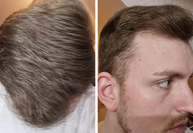 Nachher Saphir Haartransplantation mit 4200 Grafts bei Patient Marc Stehr