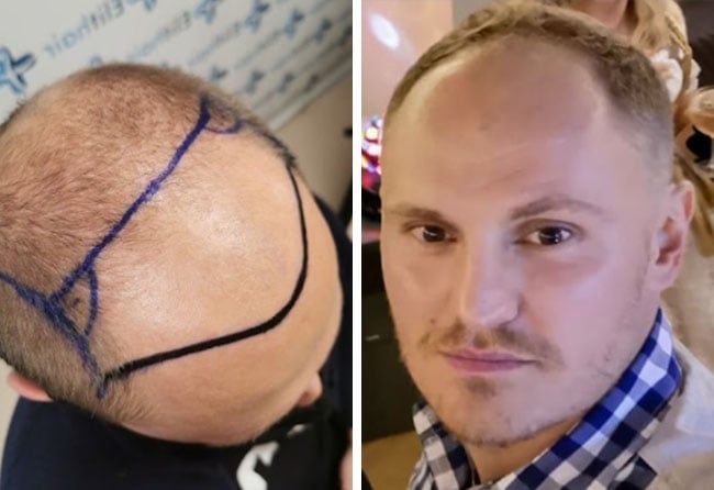 Vorher DHI Haartransplantation mit 3500 Grafts von Patient Tim Hoffmann