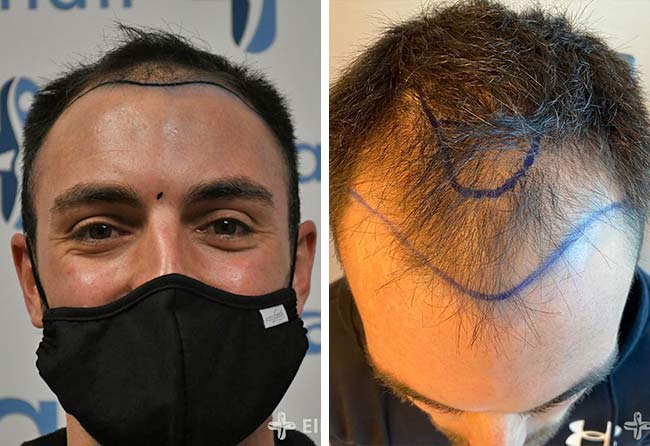Vorher DHI Haartransplantation mit 3700 Grafts von Patient Sebastian Kellermann