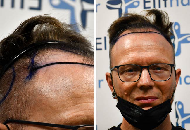 Vorher DHI Haartransplantation mit 4500 Grafts von Patient Steffen Kräuter