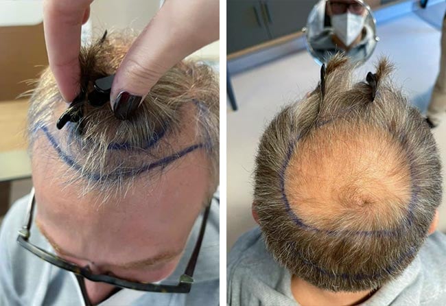 Vorher-dhi-haartransplantation-4750-grafts-Raffaele-Leucci