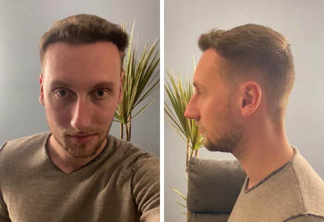 Vorher Nachher DHI Haartransplantation mit 3950 Grafts von Patient Oliver Dietrich nach 6 Monaten