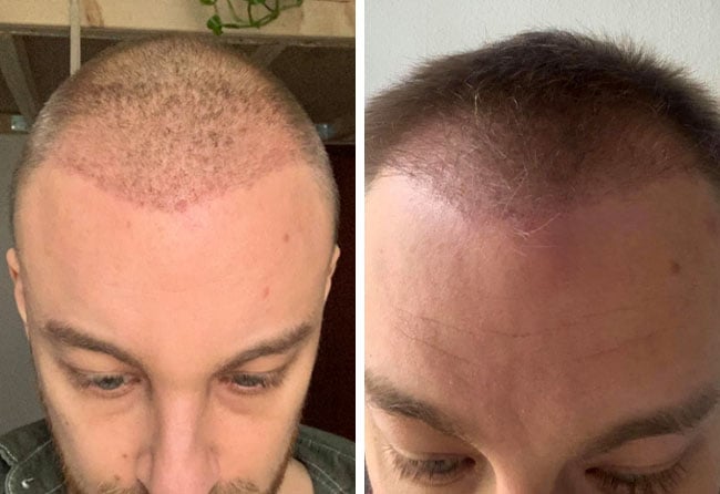 Vorher Nachher DHI Haartransplantation mit 4200 Grafts von Patient Marius Schmiddi nach 4 Monaten