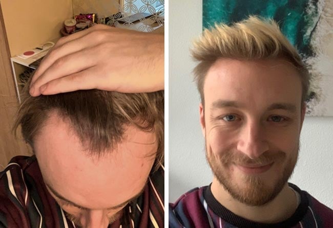 Vorher Nachher DHI Haartransplantation mit 4200 Grafts von Patient Marius Schmiddi