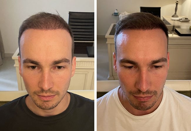 Vorher nachher DHI Haartransplantation mit 4700 Grafts bei Patient Marcel Ploch nach 6 Monaten