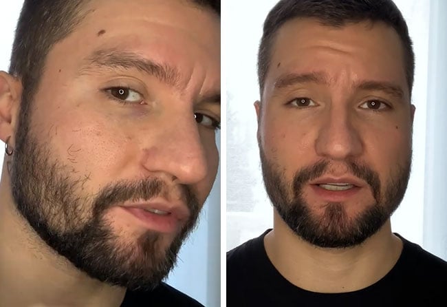 Vorher nachher Saphir Barttransplantation mit 3500 Grafts bei Patient Dominik Schmitz nach 3 Monaten