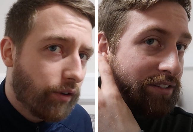 Vorher nachher Saphir Barttransplantation mit 4200 Grafts bei Patient Jay Jones nach 4 Monaten