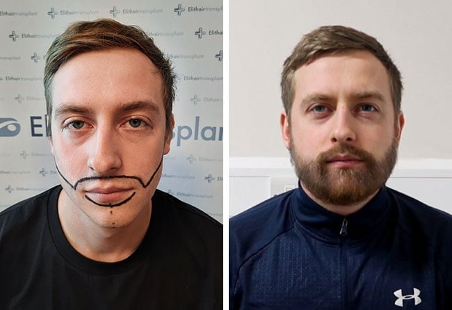 Vorher Nachher Saphir Barttransplantation mit 4200 Grafts von Patient Jay Jones