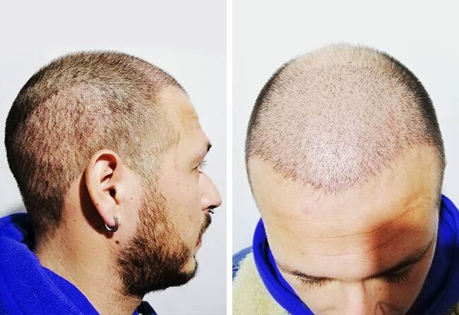 Vorher Nachher Saphir Haartransplantation mit 4200 Grafts von Patient Jorge Díaz nach 1 Monat