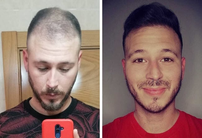 Vorher Nachher Saphir Haartransplantation mit 4200 Grafts von Patient Jorge Díaz