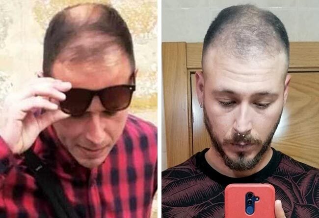 Vorher Saphir Haartransplantation mit 4200 Grafts von Patient Jorge Díaz