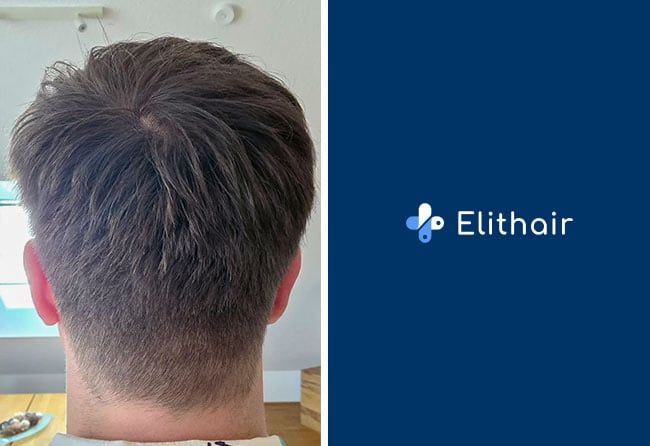 Spenderbereich von Patient Achim nach der Haartransplantation nach 5 Monaten