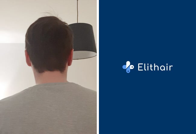 Haartransplantation Vorher Nachher Spenderbereich nach 5 Monaten von Patient Chris