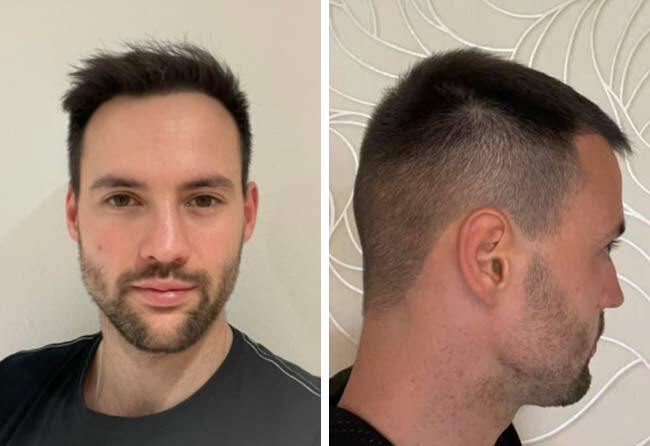 Nachher Saphir Haartransplantation mit 2700 Grafts bei Patient Thomas S.