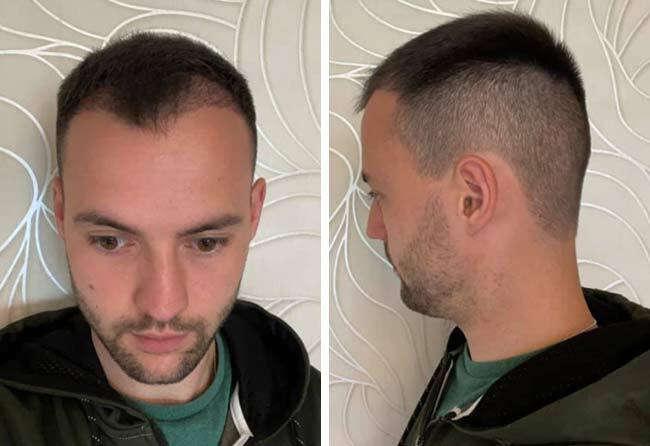 Vorher nachher Saphir Haartransplantation mit 2700 Grafts bei Patient Thorsten S. nach 2 Monaten