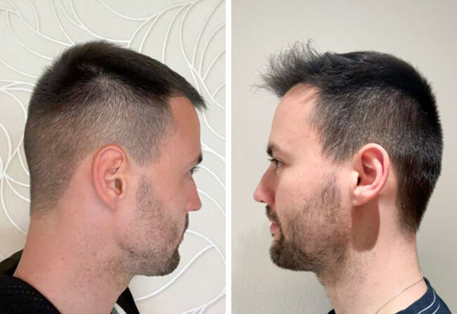 Haartransplantation Vorher Nachher Spenderbereich bei Patient Thorsten S. nach 6 Monaten