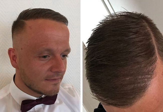Nachher DHI Haartransplantation mit 5200 Grafts von Patient Dominik König