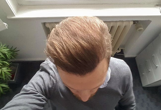 Nachher Saphir Haartransplantation mit 3700 Grafts von Patient Stefan Heckman