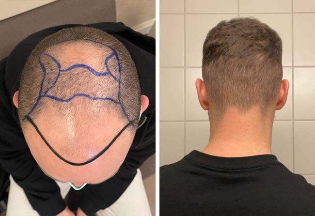 Vorher-Nachher-Vergleich der Haarlinie von Kriss Kross. Links dunkle Linien zur Markierung der neuen Haarlinie, rechts dichtes, gestyltes dunkles Haar mit präziser Kontur