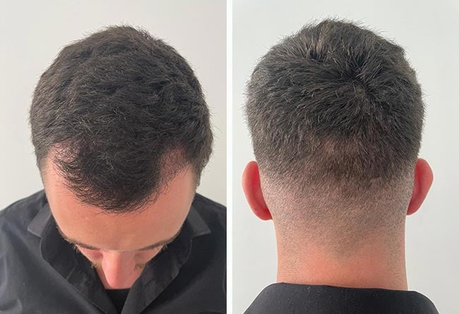 Cilian W nach 2 Monaten DHI Haartransplantation mit 3140 Grafts