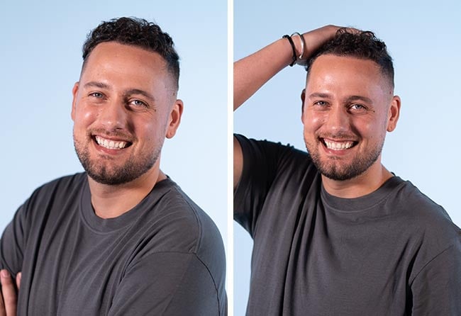 Ergebnis der DHI Haartransplantation mit 4000 Grafts bei Monier Achahbar