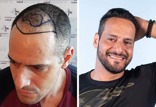 Patient Rawderson A Vorher Nachher Saphir Haartransplantation 3500 Grafts