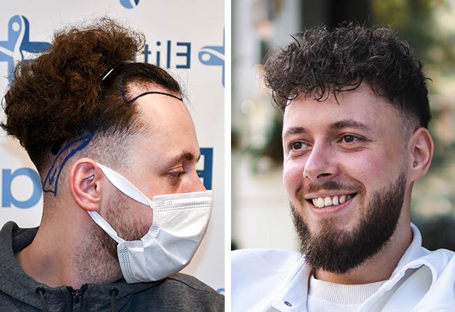Patient Cilian W. im Vorher Nachher Vergleich nach der DHI Haartransplantation mit 3140 Grafts