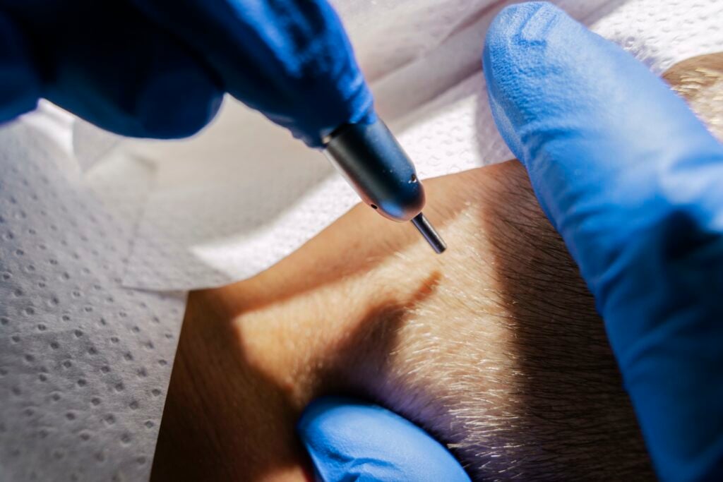 Spezialist führt eine FUE Haartransplantation mit einer Hohlnadel durch