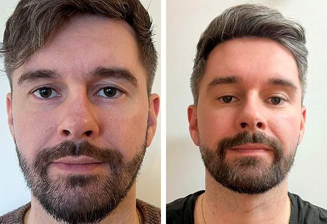 Ergebnis einer Barttransplantation bei einem Patienten. Zwei Frontalansichten desselben Mannes mit dichtem, gleichmäßig gewachsenem und gepflegtem dunklem Vollbart sowie Schnurrbart nach einem Eingriff mit 4250 Grafts.