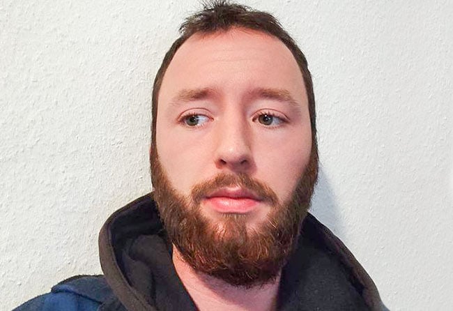 Nachher Saphir Barttransplantation mit 3700 Grafts bei Patient Felix V.