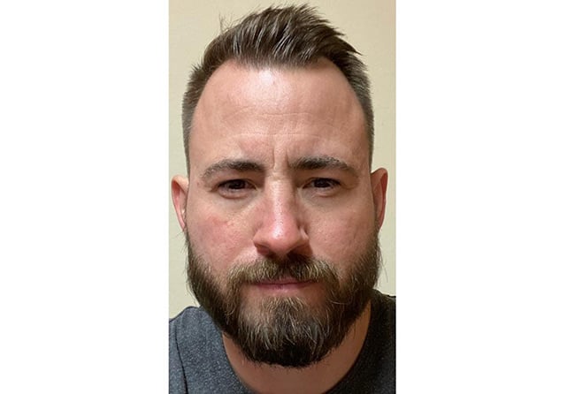 Nachher Saphir Barttransplantation mit 4200 Grafts bei Patient Steven A.