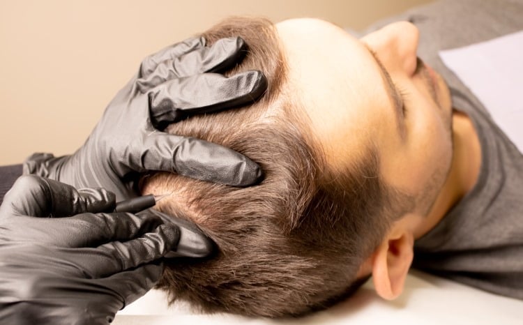 Bei einem Patienten wird eine Haarpigmentierung zur Verdichtung durchgeführt