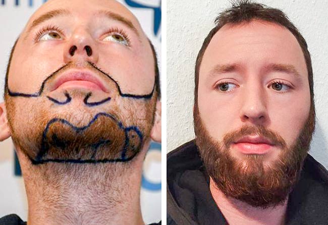 Vorher nachher Saphir Barttransplantation mit 3700 Grafts bei Patient Felix V.