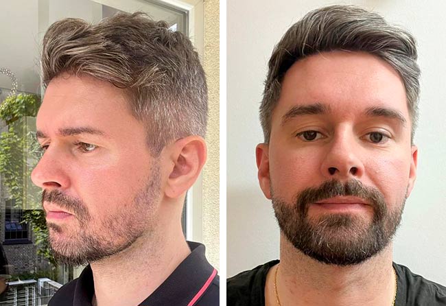 Vorher nachher Saphir Barttransplantation mit 4250 Grafts bei Patient Ismar S.