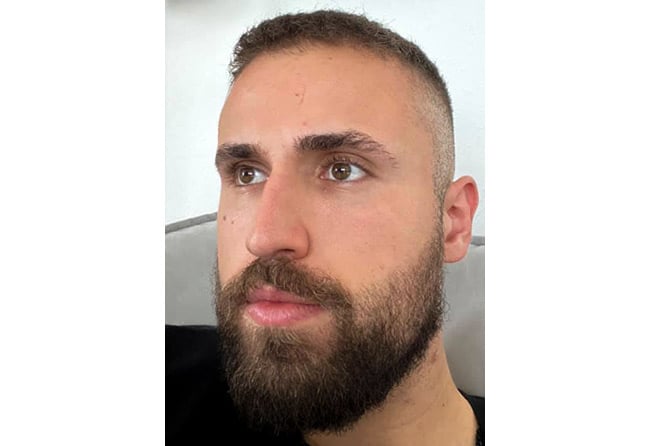 Vorher nachher Saphir Barttransplantation mit 3300 Grafts bei Patient Hu Le nach 8 Monaten