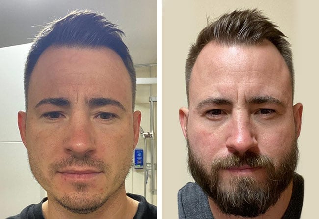 Vorher nachher Saphir Barttransplantation mit 4200 Grafts bei Patient Steven A.