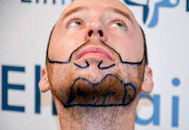 Vorher Saphir Barttransplantation mit 3700 Grafts bei Patient Felix V.