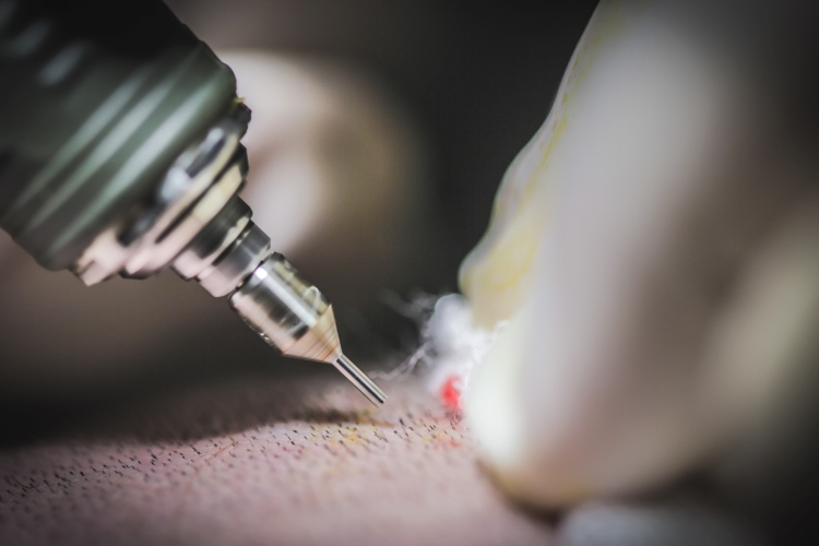 Medizinisches Instrument bei einer Haartransplantation. Eine spezialisierte FUE-Hohlnadel setzt präzise an einer rasierten Kopfhaut mit Haarstoppeln an; chirurgische Handschuhe sind im Anschnitt sichtbar.