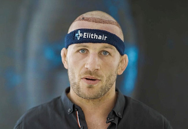 Stephan Pütz einen Tag nach seiner DHI Haartransplantation